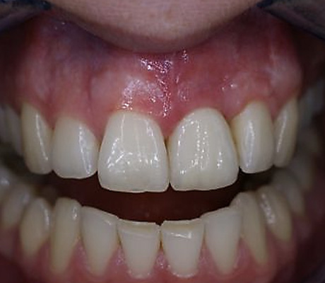 fertige Implantat Krone Zahn 21