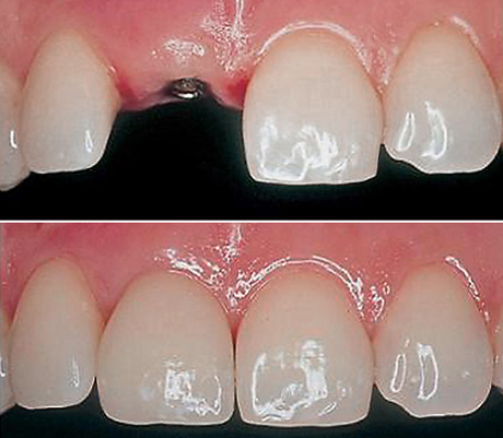 Implantat Lösung Zahn 11