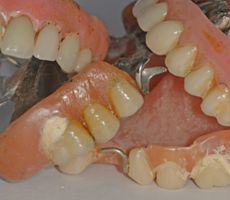 Zahnstein an alten Zahnprothesen