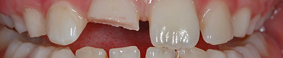 Zahnunfall / Mundschutz